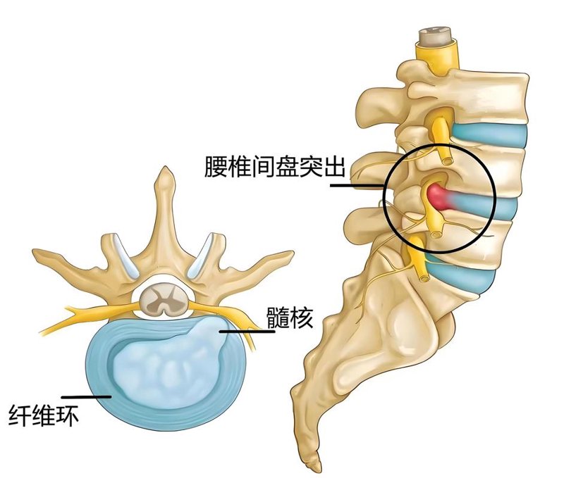 聚焦脊椎病:探索脊椎健康的新篇章
