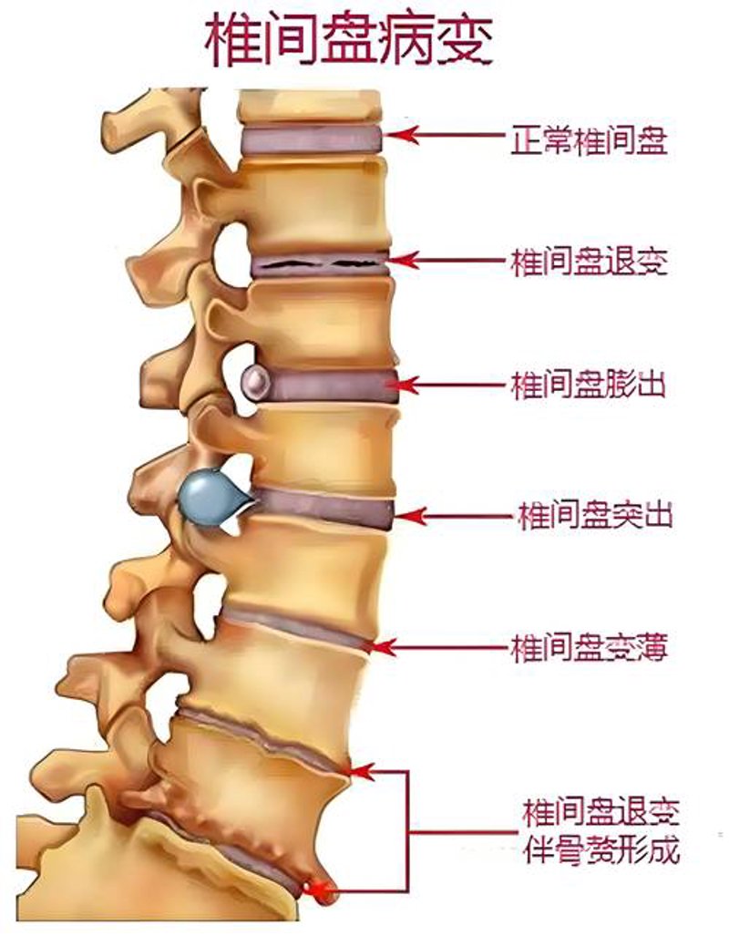 脊椎病防治新动态:科技赋能健康生活
